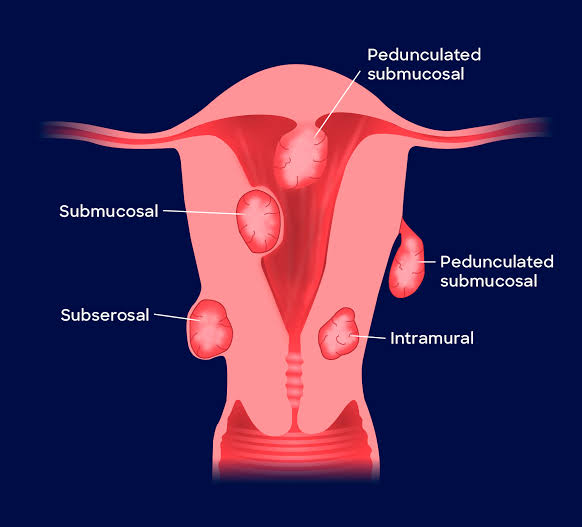 UTERINE MYOMA 