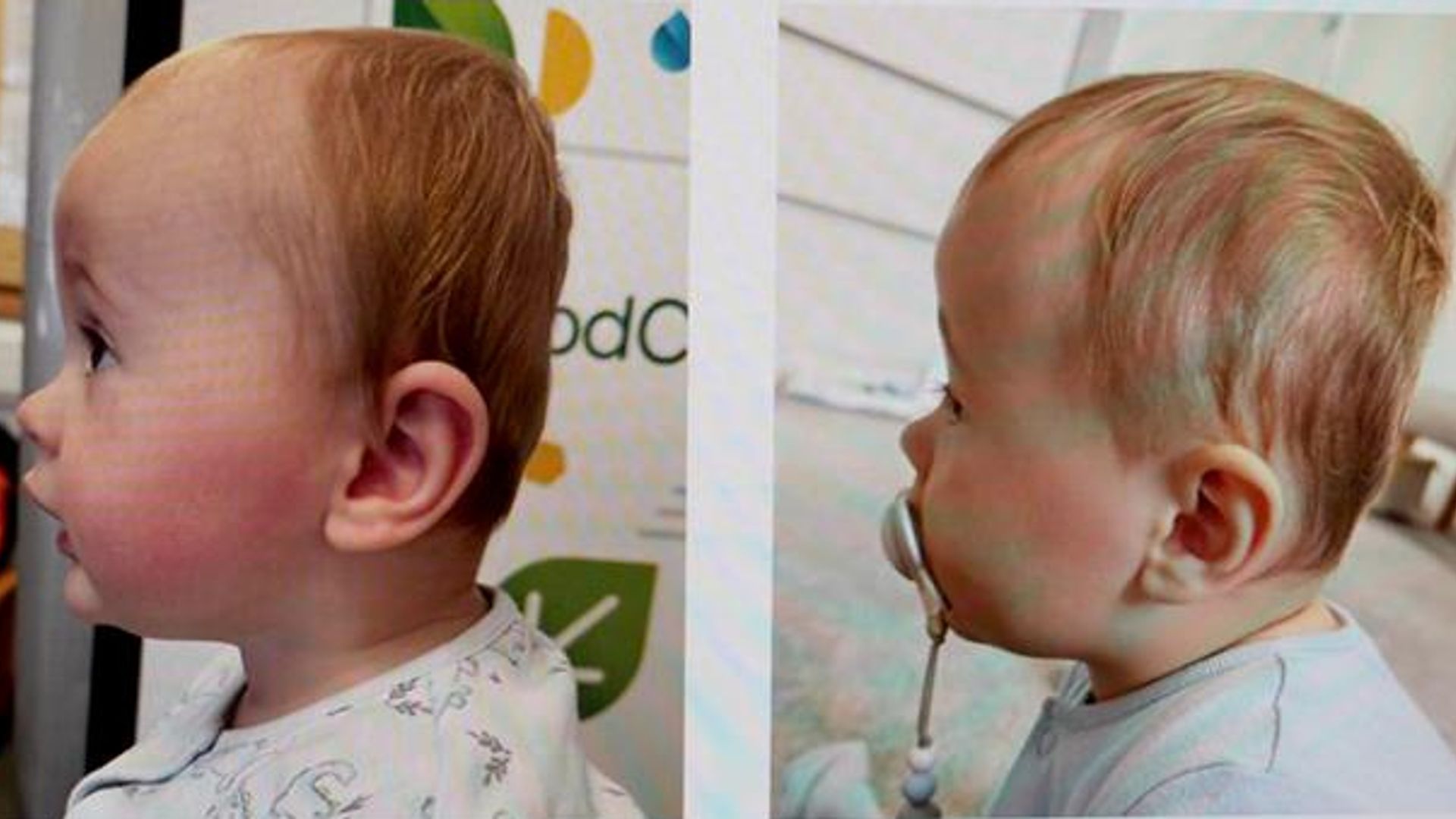 Flat head syndrome affects up to 40% of babies - but what is it and do helmets work?