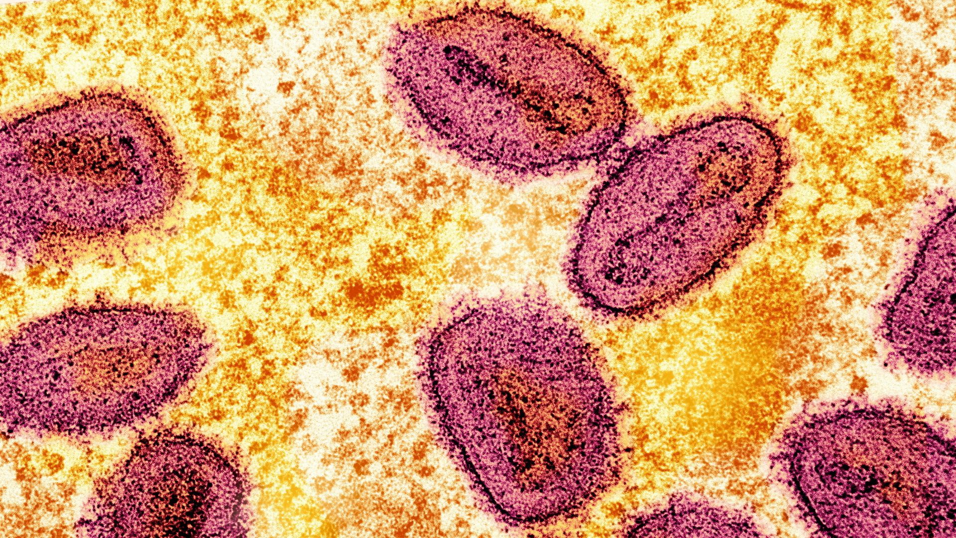 New case of mpox detected in England