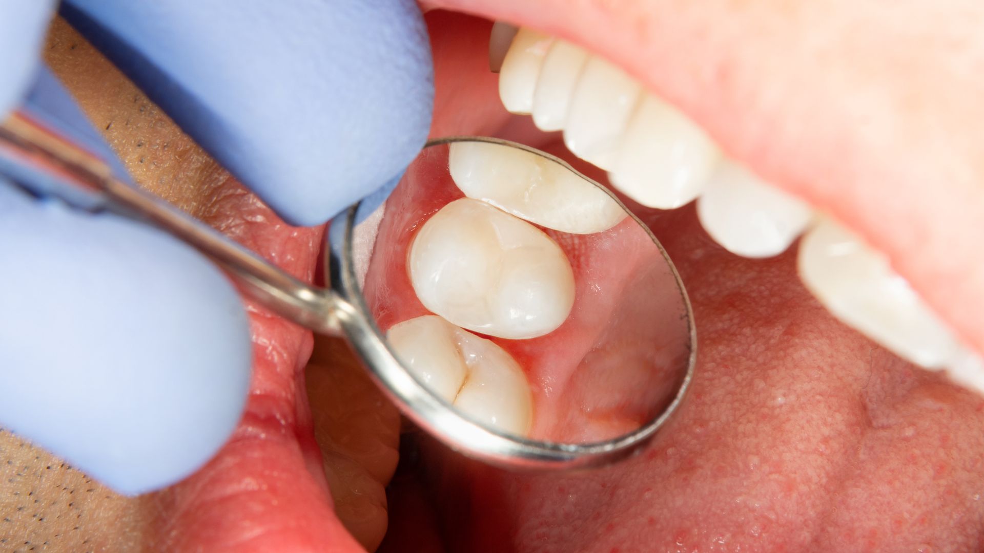 Extra 700,000 dentist appointments to be available in 'dental deserts'